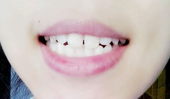 成人牙齿稀疏治疗效果好吗? 成人牙齿稀疏治疗效果好吗?