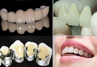 南京全瓷牙和烤瓷牙哪个好