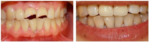 南京去哪里做牙齿修复好?