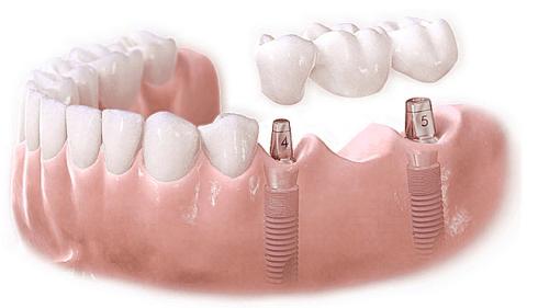 南京镶牙需要多长时间?