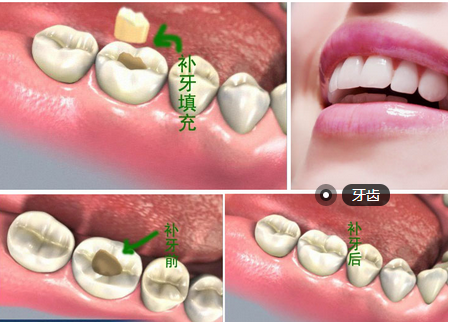 南京补牙洞多少钱一颗？