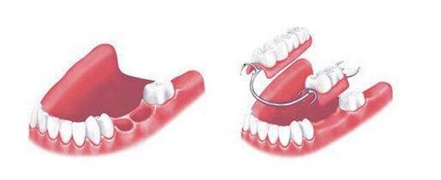 全口假牙多少钱?